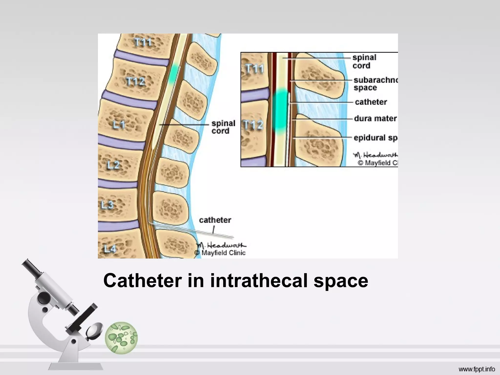 Catheter in intrathecal space