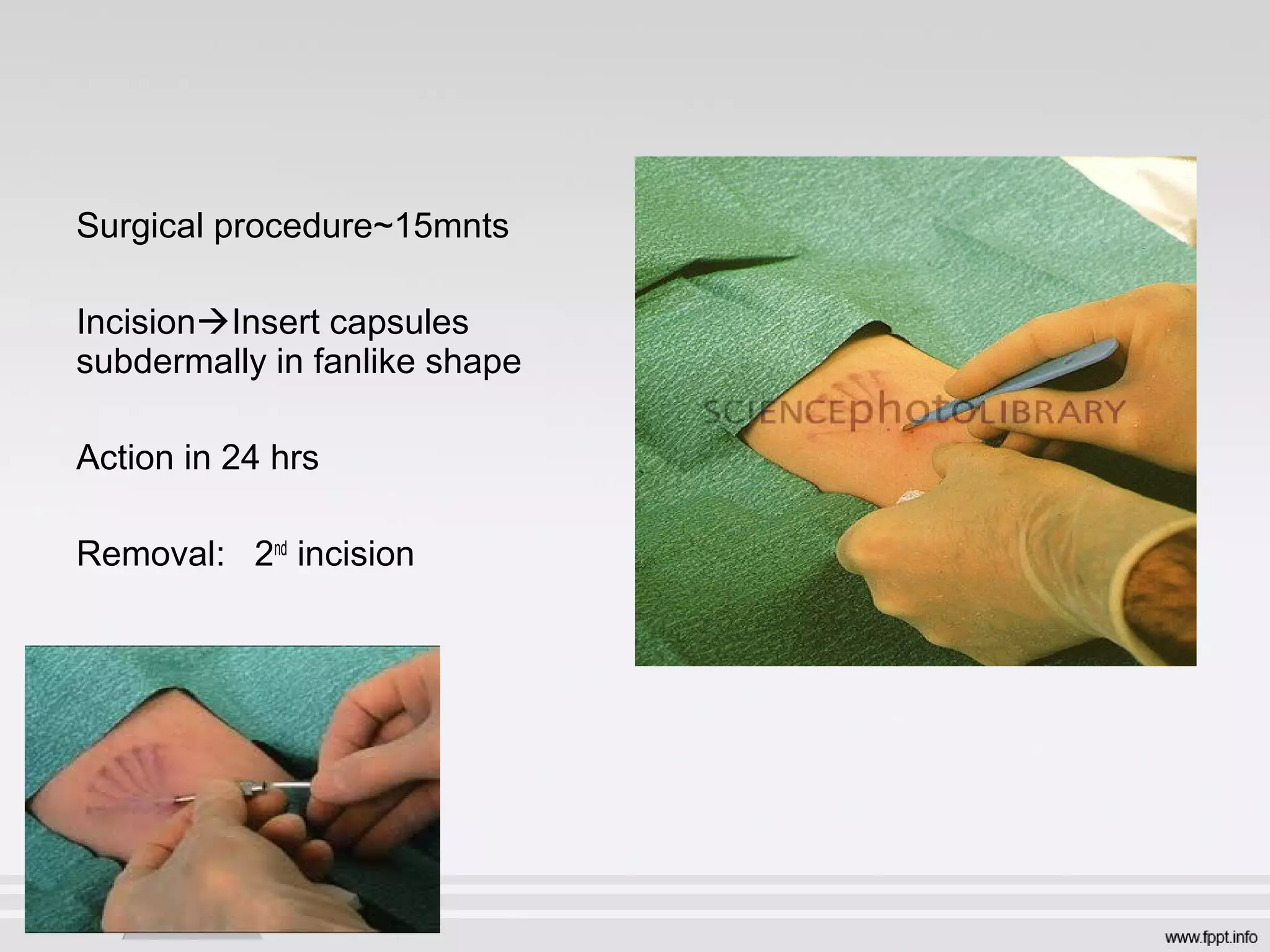 Surgical procedure~15mnts
IncisionInsert capsules
subdermally in fanlike shape
Action in 24 hrs
Removal: 2nd
incision