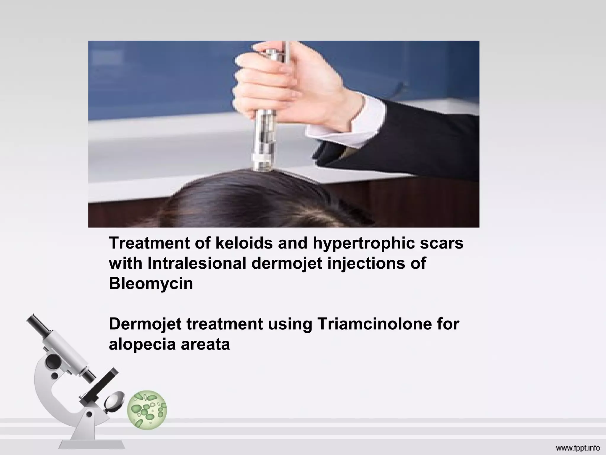 Treatment of keloids and hypertrophic scars
with Intralesional dermojet injections of
Bleomycin
Dermojet treatment using Triamcinolone for
alopecia areata