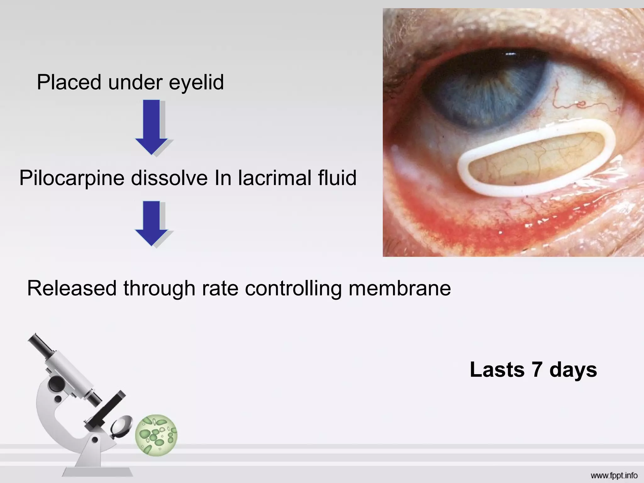 Placed under eyelid
Pilocarpine dissolve In lacrimal fluid
Released through rate controlling membrane
Lasts 7 days