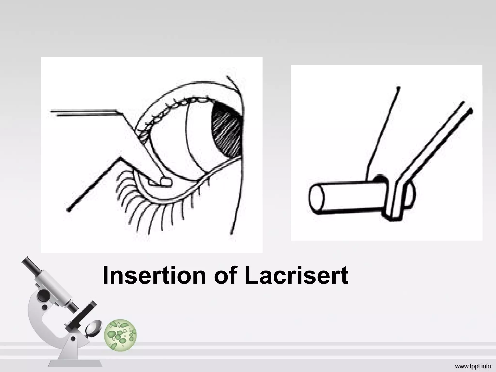 Insertion of Lacrisert