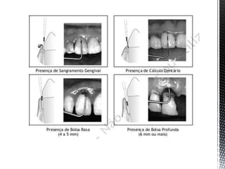 íNdices de condição periodontal
