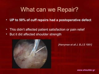 What can we Repair?
• UP to 50% of cuff repairs had a postoperative defect
• This didn’t affected patient satisfaction or ...