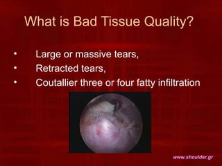 What is Bad Tissue Quality?
• Large or massive tears,
• Retracted tears,
• Coutallier three or four fatty infiltration
www...
