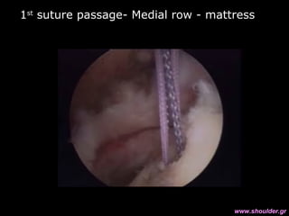 1st
suture passage- Medial row - mattress
www.shoulder.gr
 