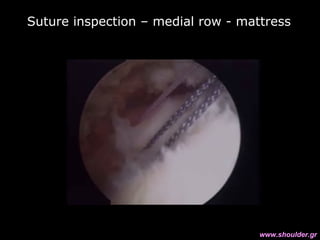 Suture inspection – medial row - mattress
www.shoulder.gr
 