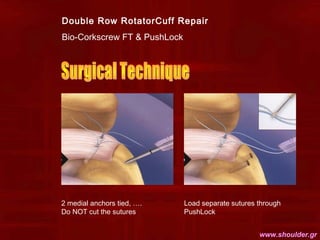 Double Row RotatorCuff Repair
Bio-Corkscrew FT & PushLock
2 medial anchors tied, ….
Do NOT cut the sutures
Load separate s...