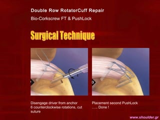Double Row RotatorCuff Repair
Bio-Corkscrew FT & PushLock
Disengage driver from anchor
6 counterclockwise rotations, cut
s...