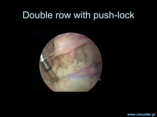 Conclusions
• Double row provides maximum strength of
initial fixation
• Restores the footprint of the rot cuff
• Although...