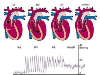 Principles of management of acute heart failure | PPTX