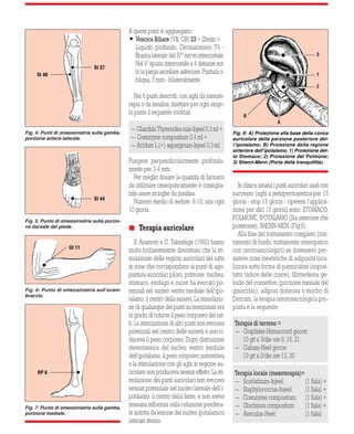 A questi punti si aggiungano: 
 Vescica Biliare (VB, GB) 23 = Zhejin = 
Liquido profondo. Dermatomero T4 - 
Branca laterale del IVº nervo intercostale. 
Nel 4º spazio intercostale a 4 distanze sot-to 
la piega ascellare anteriore. Puntura o-bliqua, 
5 mm - bilateralmente 
Nei 6 punti descritti, con aghi da mesote-rapia 
o da insulina, iniettare per ogni singo-lo 
punto il seguente cocktail: 
-Glandula Thyreoidea suis-Injeel 0,3 ml + 
-Coenzyme compositum 0,4 ml + 
-Acidum L (+) aspargicum-Injeel 0,3 ml 
Pungere perpendicolarmente profonda-mente 
21 
per 3-4 mm. 
Per meglio dosare la quantità di farmaco 
da utilizzare omeopaticamente è consiglia-bile 
usare siringhe da insulina. 
Numero medio di sedute: 8-10, una ogni 
10 giorni. 
 Terapia auricolare 
S. Asamoto e C. Takeshige (1992) hanno 
molto brillantemente dimostrato che la sti-molazione 
delle regioni auricolari del ratto 
in zone che corrispondono ai punti di ago-puntura 
auricolari piloro, polmone, trachea, 
stomaco, esofago e cuore ha evocato po-tenziali 
nel nucleo ventro mediale dell’ipo-talamo, 
il centro della sazietà. La stimolazio-ne 
di qualunque dei punti su menzionati era 
in grado di ridurre il peso corporeo dei rat-ti. 
La stimolazione di altri punti non evocava 
potenziali nel centro delle sazietà e non ri-duceva 
il peso corporeo. Dopo distruzione 
stereotassica del nucleo ventro mediale 
dell’ipotalamo, il peso corporeo aumentava 
e la stimolazione con gli aghi in regione au-ricolare 
non produceva nessun effetto. La sti-molazione 
dei punti auricolari non evocava 
nessun potenziale nel nucleo laterale dell’i-potalamo, 
il centro della fame, e non aveva 
nessuna influenza sulla riduzione pondera-le 
indotta da lesione del nucleo ipotalamico 
laterale stesso. 
3 
1 
2 
B 
A 
In clinica umana i punti auricolari usati con 
successo (aghi a semipermanenza per 15 
giorni - stop 15 giorni - ripetere l’applica-zione 
per altri 15 giorni) sono: STOMACO, 
POLMONE, IPOTALAMO (Sia anteriore che 
posteriore), SHENN-MEN. (Fig.8). 
Alla fine del trattamento completo (trat-tamento 
di fondo, trattamento omeopatico 
con omotossicologici) se dovessero per-sistere 
zone inestetiche di adiposità loca-lizzata 
sotto forma di panniculosi (soprat-tutto 
radice delle cosce), fibroedema ge-loide 
del connettivo (porzione mesiale del 
ginocchio), adiposi dolorosa o morbo di 
Dercum, la terapia omotossicologica pro-posta 
è la seguente: 
Terapia di terreno = 
- Graphites Homaccord gocce: 
10 gtt x 3/die ore 9, 16, 21 
- Galium-Heel gocce: 
10 gtt x 2/die ore 12, 20 
Terapia locale (mesoterapia)= 
- Scarlatinum-Injeel: (1 fiala) + 
- Staphylococcus-Injeel: (1 fiala) + 
- Coenzyme compositum: (1 fiala) + 
- Ubichinon compositum: (1 fiala) + 
- Aesculus-Heel: (1 fiala) 
Fig. 4: Punti di omeosiniatria sulla gamba, 
porzione antero-laterale. 
Fig. 5: Punto di omeosiniatria sulla porzio-ne 
dorsale del piede. 
Fig. 6: Punto di omeosiniatria sull’avam-braccio. 
Fig. 7: Punto di omeosiniatria sulla gamba, 
porzione mediale. 
Fig. 8: A) Proiezione alla base della conca 
auricolare della porzione posteriore del-l’ipotalamo; 
B) Proiezione della regione 
anteriore dell’ipotalamo. 1) Proiezione del-lo 
Stomaco; 2) Proiezione del Polmone; 
3) Shenn-Menn (Porta della tranquillità). 
St 37 
St 44 
GI 11 
St 40 
RP 6 
 