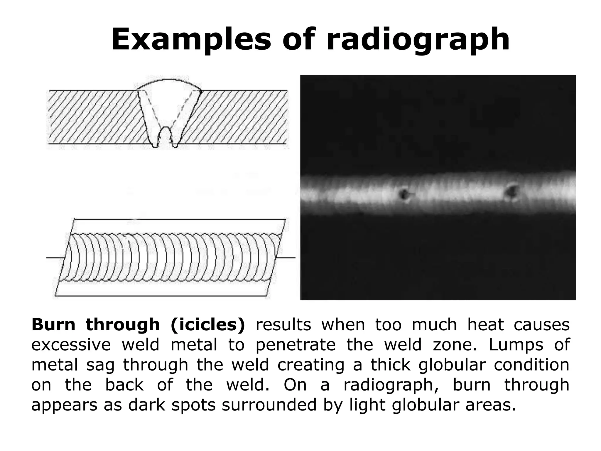 Burn through (icicles) results when too much heat causes
excessive weld metal to penetrate the weld zone. Lumps of
metal sag through the weld creating a thick globular condition
on the back of the weld. On a radiograph, burn through
appears as dark spots surrounded by light globular areas.
Examples of radiograph
 