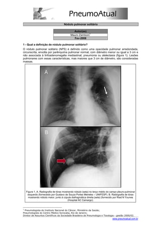 Nódulo pulmonar solitário

                                             Autor(es)
                                                         1
                                           Mauro Zamboni
                                             Fev-2008

1 - Qual a definição de nódulo pulmonar solitário?
O nódulo pulmonar solitário (NPS) é definido como uma opacidade pulmonar arredondada,
circunscrita, envolta por parênquima pulmonar normal, com diâmetro menor ou igual a 3 cm e
não associada à linfoadenomegalia mediastinal, pneumonia ou atelectasia (figura 1). Lesões
pulmonares com essas características, mas maiores que 3 cm de diâmetro, são consideradas
massas.




  Figura 1. A. Radiografia de tórax mostrando nódulo (seta) no terço médio do campo pleuro-pulmonar
   esquerdo (forneceido por Gustavo de Souza Portes Meireles – UNIFESP). B. Radiografia de tórax
    mostrando nódulo maior, junto à cúpula diafragmática direita (seta) (fornecido por Riad N Younes
                                        (Hospital AC Camargo).


1
  Pneumologista do Instituto Nacional do Câncer, Ministério da Saúde;
Pneumologista do Centro Médico Sorocaba, Rio de Janeiro;
Diretor de Assuntos Científicos da Sociedade Brasileira de Pneumologia e Tisiologia - gestão 2000/02.
                                                                                 www.pneumoatual.com.br
 