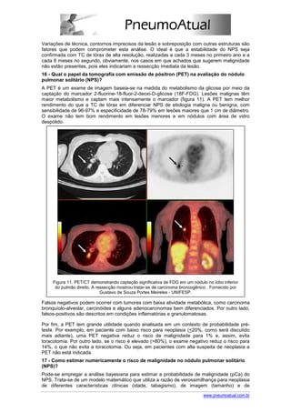Variações de técnica, contornos imprecisos da lesão e sobreposição com outras estruturas são
fatores que podem comprometer esta análise. O ideal é que a estabilidade do NPS seja
confirmada com TC de tórax de alta resolução, realizadas a cada 3 meses no primeiro ano e a
cada 6 meses no segundo, obviamente, nos casos em que achados que sugerem malignidade
não estão presentes, pois eles indicariam a ressecção imediata da lesão.
16 - Qual o papel da tomografia com emissão de pósitron (PET) na avaliação do nódulo
pulmonar solitário (NPS)?
A PET é um exame de imagem baseia-se na medida do metabolismo da glicose por meio da
captação do marcador 2-fluorine-18-fluor-2-deoxi-D-glicose (18F-FDG). Lesões malignas têm
maior metabolismo e captam mais intensamente o marcador (figura 11). A PET tem melhor
rendimento do que a TC de tórax em diferenciar NPS de etiologia maligna ou benigna, com
sensibilidade de 96-97% e especificidade de 78-79% em lesões maiores que 1 cm de diâmetro.
O exame não tem bom rendimento em lesões menores e em nódulos com área de vidro
despolido.




     Figura 11. PET/CT demonstrando captação significativa de FDG em um nódulo no lobo inferior
      do pulmão direito. A ressecção mostrou tratar-se de carcinoma broncogênico . Fornecido por
                             Gustavo de Souza Portes Meireles - UNIFESP.

Falsos negativos podem ocorrer com tumores com baixa atividade metabólica, como carcinoma
bronquíolo-alveolar, carcinóides e alguns adenocarcinomas bem diferenciados. Por outro lado,
falsos-positivos são descritos em condições inflamatórias e granulomatosas.

Por fim, a PET tem grande utilidade quando analisada em um contexto de probabilidade pré-
teste. Por exemplo, em paciente com baixo risco para neoplasia (<20%, como será discutido
mais adiante), uma PET negativa reduz o risco de malignidade para 1% e, assim, evita
toracotomia. Por outro lado, se o risco é elevado (>80%), o exame negativo reduz o risco para
14%, o que não evita a toracotomia. Ou seja, em pacientes com alta suspeita de neoplasia a
PET não está indicada.
17 - Como estimar numericamente o risco de malignidade no nódulo pulmonar solitário
(NPS)?
Pode-se empregar a análise bayesiana para estimar a probabilidade de malignidade (pCa) do
NPS. Trata-se de um modelo matemático que utiliza a razão de verossimilhança para neoplasia
de diferentes características clínicas (idade, tabagismo), de imagem (tamanho) e de

                                                                              www.pneumoatual.com.br
 