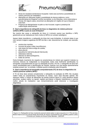 •   Sinais de neoplasia extratorácica insuspeita: neste caso aumenta a possibilidade do
        nódulo pulmonar ser metastático.
    •   Alterações em diferentes órgãos: possibilidade de doença sistêmica, como
        granulomatose de Wegener e artrite reumatóide, ou de infecções, como tuberculose e
        micose. Em alguns casos, encontram-se alterações em órgãos em que a biópsia é
        mais fácil.
    •   Presença de telangectasias na pele ou nas mucosas: sugere a presença de
        malformação arteriovenosa.
8 - Qual a importância da radiografia de tórax no diagnóstico do nódulo pulmonar
solitário (NPS) e quais as suas limitações?
Na maioria das vezes a radiografia de tórax é o primeiro exame que identifica o NPS,
geralmente ao ser realizada por outro motivo (o NPS é um achado radiológico).

Apesar desta importância, a radiografia de tórax tem suas limitações. A primeira delas é que
nem sempre imagens sugestivas de NPS de fato o são, devendo-se ter cuidado, por exemplo,
com:
    •   sombra dos mamilos,
    •   tumores de partes moles (neurofibroma),
    •   calo ósseo de fratura antiga de costela,
    •   placa pleural,
    •   pseudotumor (derrame pleural intercisural),
    •   atelectasia redonda,
    •   eletrodo do eletrocardiograma,
    •   botão da camisa.
Outra limitação importante diz respeito às características do nódulo que sugerem maiores ou
menores chances de malignidade ou benignidade, todas mais facilmente identificadas na
tomografia computadorizada do que na radiografia de tórax. Por fim, a radiografia de tórax tem
menor sensibilidade para a identificação de nódulos, fazendo com que lesões aparentemente
isoladas possam ser, na verdade, múltiplas quando analisadas pela tomografia.
9 - Qual a importância da tomografia computadorizada (TC) de tórax no diagnóstico do
nódulo pulmonar solitário (NPS)?
A TC de tórax deve sempre complementar a radiografia na avaliação do NPS. Ela visualiza
melhor todas as características importantes do nódulo, como será discutido adiante. Ela
distingue melhor o nódulo de alterações da parede torácica (figura 2), pode identificar lesões
adicionais, analisa melhor os ápices, regiões peri-hilares e ângulos costofrênicos e permite
melhor estudo do mediastino, cujo comprometimento pode direcionar a investigação
diagnóstica.




Figura 2. A. Radiografia de tórax mostrando possível nódulo (seta) no ápice esquerdo. B. A TCa de tórax
Mostra tratar-se de uma pseudo-lesão decorrente de artrose condroesternal com osteófito posterior (seta).
                      Fornecido por Gustavo de Souza Portes Meireles - UNIFESP.




                                                                                 www.pneumoatual.com.br
 
