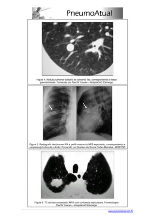 Figura 4. Nódulo pulmonar solitário de contorno liso, correspondendo a lesão
         granulomatosa. Fornecido por Riad N Younes – Hospital AC Camargo.




Figura 5. Radiografia de tórax em PA e perfil mostrando NPS espiculado, correspondendo a
neoplasia primária de pulmão. Fornecido por Gustavo de Souza Portes Meireles - UNIFESP.




    Figura 6. TC de tórax mostrando NPS com contornos espiculados. Fornecido por
                        Riad N Younes – Hospital AC Camargo.

                                                                          www.pneumoatual.com.br
 