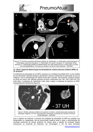 Figura 8. TC de tórax mostrando diferentes padrões de calcificação. A. Calcificação central (benigna). B.
    Calcificação concêntrica (benigna). C. Calcificação “em pipoca” (benigna). D. Calcificação difusa
 (benigna). E. Calcificação periférica (indeterminada). Em cada exame tem-se o nódulo real e, ao lado,
          uma ilustraçãodidática. Fornecido por Gustavo de Souza Portes Meireles - UNIFESP.

14 - Qual o papel da determinação da densidade do nódulo pulmonar solitário (NPS) na
TC de tórax?
O coeficiente de atenuação de um NPS, expresso em unidades Hounsfield (UH), é uma medida
de sua densidade. Nódulos benignos apresentam maiores coeficientes de atenuação do que os
malignos, mas a sobreposição de valores entre eles é grande, não havendo consenso quanto
ao ponto de corte a ser utilizado (estudos já foram conduzidos com 164, 185 e 264 UH). Por
outro lado, a presença de coeficiente muito baixo sugere a presença de gordura no NPS,
característica do hamartoma (figura 9).




      Figura 9. Nódulo pulmonar solitário com gordura no interior, caracterizada pela presença de
      densidade negativa (-37 UH). Corresponde a hamartoma. Fornecido por Gustavo de Souza
                                     Portes Meirelles – UNIFESP.

Com o objetivo de melhorar a acurácia da avaliação da densidade do NPS em predizer sua
benignidade ou malignidade, tem-se preconizado avaliá-la antes e após a administração de
contraste (protocolo de estudo dinâmico do nódulo após a injeção de contraste iodado
intravenoso ou protocolo de Swensen, em homenagem a um de seus principais
                                                                                  www.pneumoatual.com.br
 