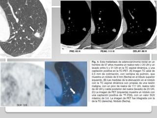 NPS: carcinoma broncogénico:
nódulo de 2.5 cm con bordes
lobulados y espiculados
                     36
 
