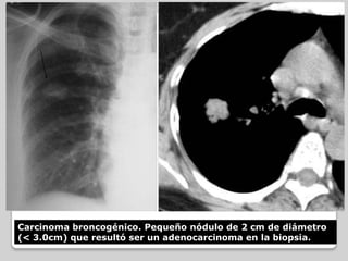 Metástasis
• Son las causas mas frecuentes de Nódulos
  pulmonares múltiples
• Se pueden originar en cualquier órgano y
  ...