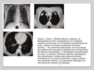 CPCP
• 25% de los canceres pulmonares
• Comportamiento agresivo y proliferación rápida
• 98% de los pacientes que lo prese...