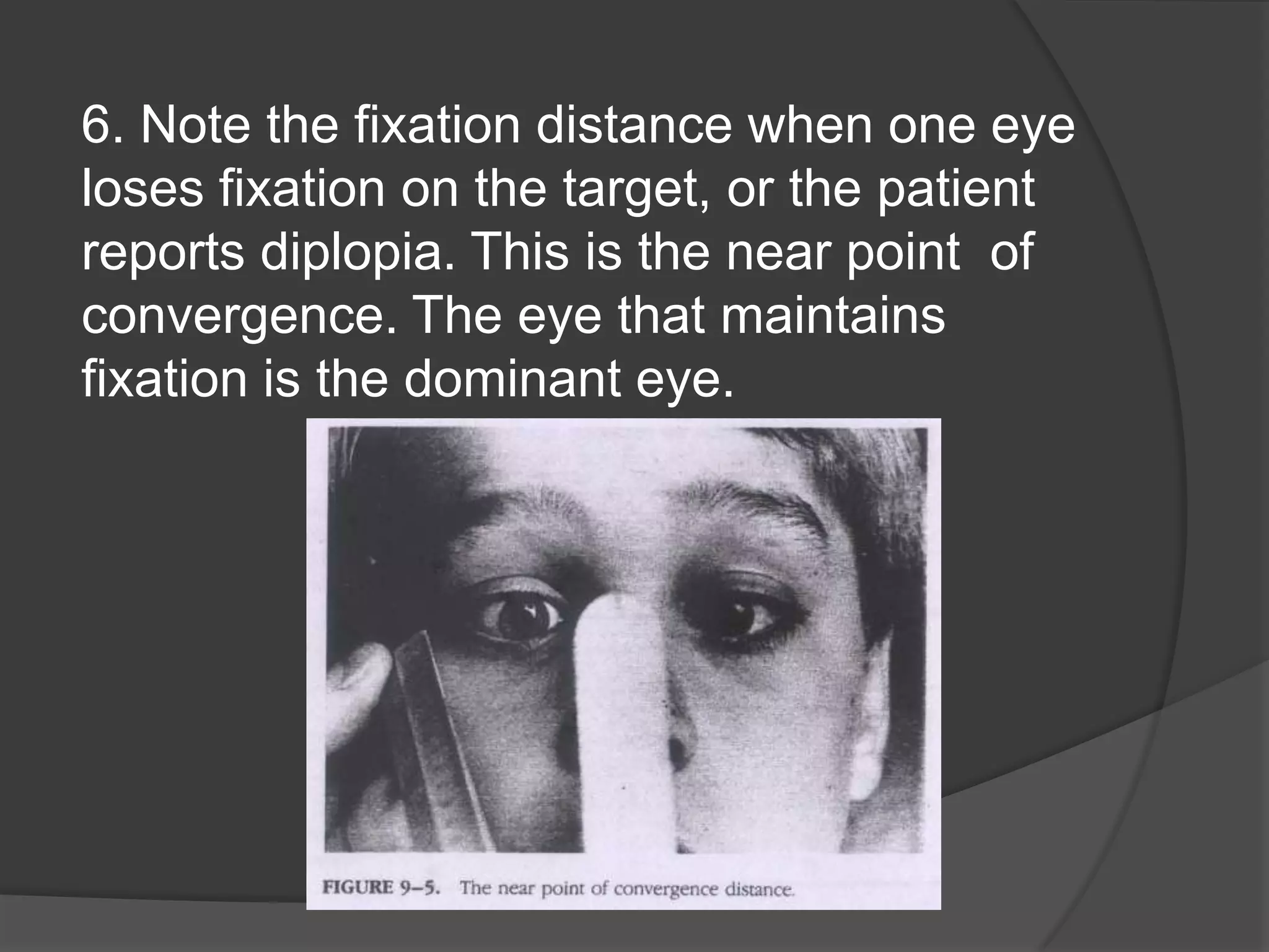 6. Note the fixation distance when one eye
loses fixation on the target, or the patient
reports diplopia. This is the near point of
convergence. The eye that maintains
fixation is the dominant eye.

 