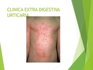 CLINICA EXTRA DIGESTIVA
URTICARIA
 