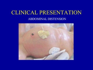 CLINICAL PRESENTATION
     ABDOMINAL DISTENSION
 