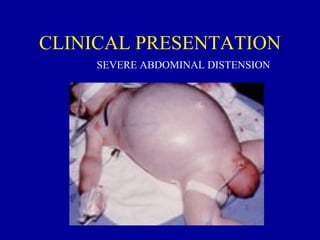 CLINICAL PRESENTATION
     SEVERE ABDOMINAL DISTENSION
 