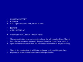 •   ORIGINAL REPORT
•   HISTORY
•   NEC, septic shock on CPAP, IA and IV lines.

•   REPORT
•   AXR - SUPINE AP

•   Compared with AXR taken 10 hours earlier.

•   The nasogastric tube is now seen projected over the left hypochondrium. There is
•   interval worsening of the gaseously distended intestinal loops. Faecal matter is
•   again seen in the proximal colon. No air or faecal matter seen in the pelvic cavity.


•   There is free extraluminal air within the peritoneal cavity, outlining the liver.
•   Rigler's sign is noted, consistent with intestinal perforation.
 