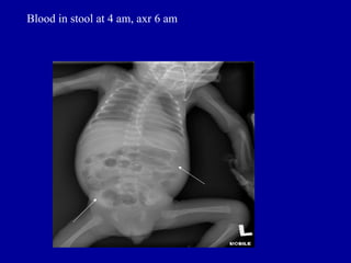 Blood in stool at 4 am, axr 6 am
 