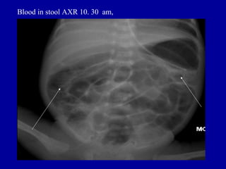 Blood in stool AXR 10. 30 am,
 
