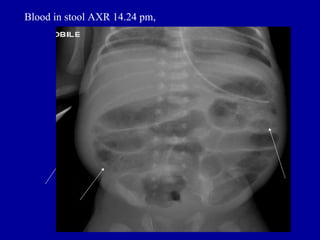 Blood in stool AXR 14.24 pm,
 