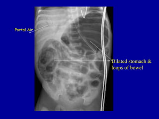 Portal Air




             Dilated stomach &
             loops of bowel
 
