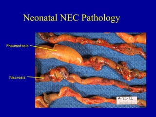 Neonatal NEC Pathology

Pneumatosis




 Necrosis
 