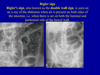 Rigler sign
Rigler's sign, also known as the double wall sign, is seen on
an x-ray of the abdomen when air is present on both sides of
 the intestine, i.e. when there is air on both the luminal and
              peritoneal side of the bowel wall.
 