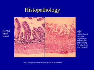 Histopathology


Normal                                                             NEC:
small                                                              Hemorrhagic
bowel                                                              necrosis
                                                                   beginning at
                                                                   the mucosa
                                                                   and working
                                                                   its way down
                                                                   into the wall




         http://library.med.utah.edu/WebPath/PEDHTML/PED045.html
 