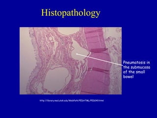 Histopathology




                                                          Pneumatosis in
                                                          the submucosa
                                                          of the small
                                                          bowel




http://library.med.utah.edu/WebPath/PEDHTML/PED049.html
 