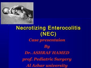Necrotizing Enterocolitis
         (NEC)
    Case presentaion
            By
   Dr. ASHRAF HAMED
  prof. Pediatric Surgery
   Al Azhar university
 