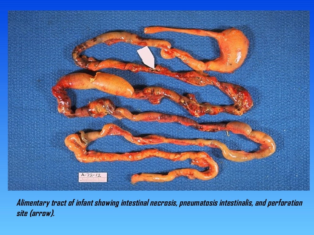 Necrotizing enterocolitis