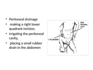 • Peritoneal drainage
• making a right lower
quadrant incision,
• irrigating the peritoneal
cavity,
• placing a small rubber
drain in the abdomen
 