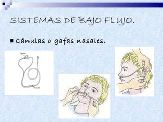 SISTEMAS DE BAJO FLUJO.   Cánulas o gafas nasales .   