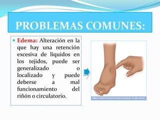 PROBLEMAS COMUNES:
 Edema: Alteración en la
 que hay una retención
 excesiva de líquidos en
 los tejidos, puede ser
 generalizado            o
 localizado     y    puede
 deberse        a      mal
 funcionamiento        del
 riñón o circulatorio.
 