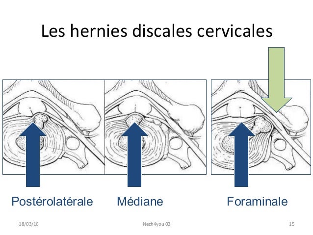 Nurse Course Pathologies Cervicales En Neurochirurgie 3 4 Nurse Course Pathologies Cervicales En Neurochirurgie 3 4