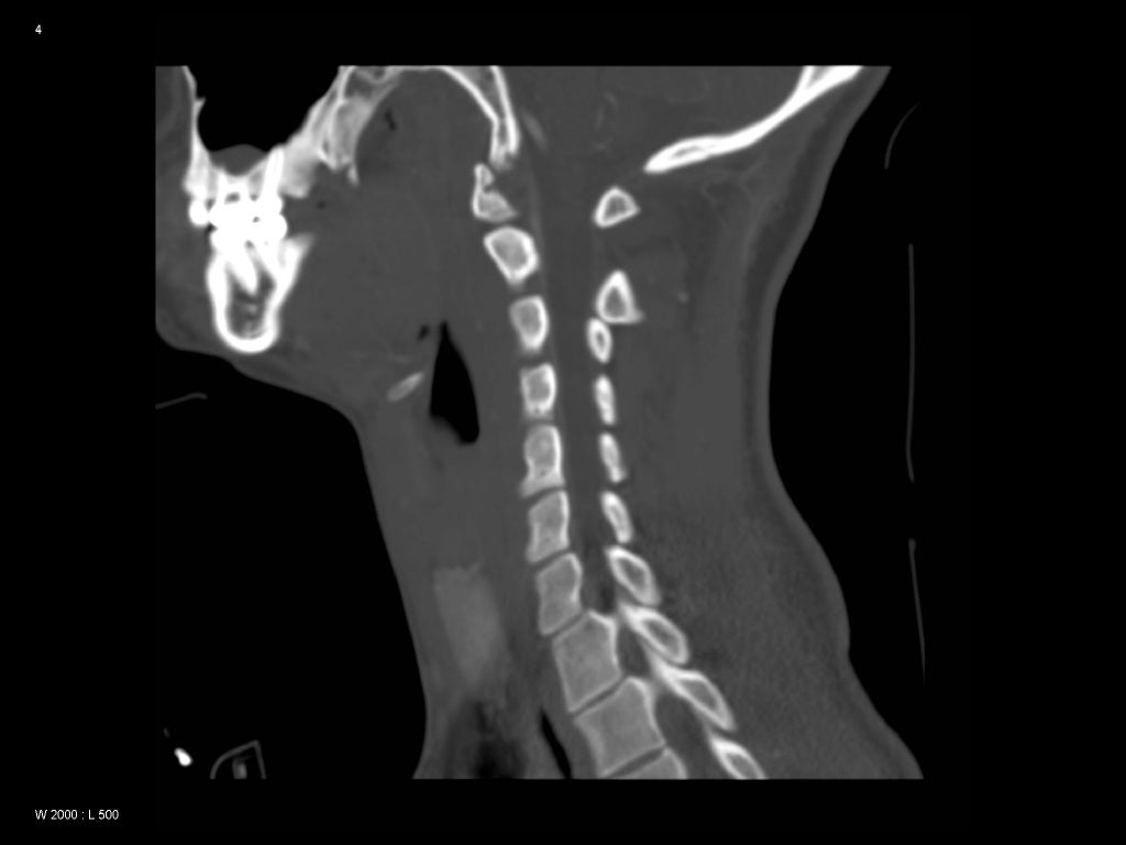 Neck Pain After Trauma