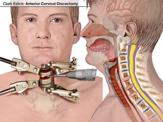 Cervical Hematoma Airway Obstruction