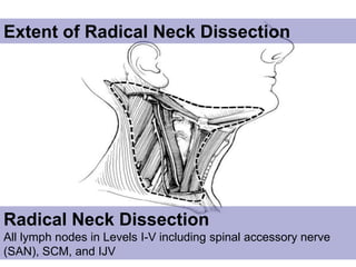 Extent of Radical Neck Dissection Radical Neck Dissection All lymph nodes in Levels I-V including spinal accessory nerve (SAN), SCM, and IJV