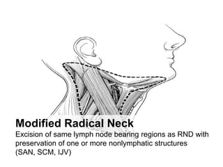 Modified Radical NeckExcision of same lymph node bearing regions as RND with preservation of one or more nonlymphatic structures (SAN, SCM, IJV)