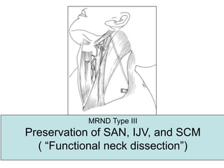 MRND Type IIIPreservation of SAN, IJV, and SCM ( “Functional neck dissection”)