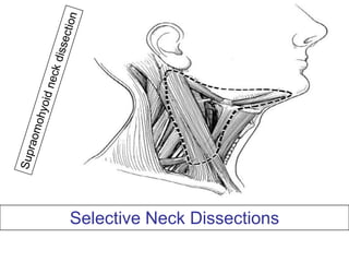 Supraomohyoid neck dissectionSelective Neck Dissections