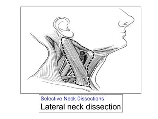 Selective Neck DissectionsLateral neck dissection